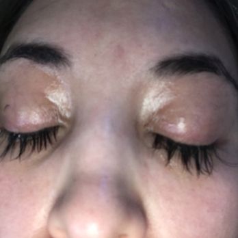 Skin Secrets & Threading - Swollen. Glue used was trash. Last clumps won't fall, none of my eyelashes remain. proof that she left me on red when I asked for help - Threading Services Near Me - Northglenn, Colorado Skin Secrets & Threading - Swollen. Glue used was trash. Last clumps won't fall, none of my eyelashes remain. proof that she left me on red when I asked for help - Threading Services Near Me - Northglenn, Colorado