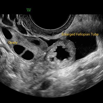 Advanced Sonograms of Alaska - Ovary and enlarged fallopian tube - Reproductive Health Services Near Me - Anchorage, Alaska Advanced Sonograms of Alaska - Ovary and enlarged fallopian tube - Reproductive Health Services Near Me - Anchorage, Alaska