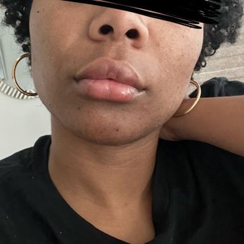 Ideal Image Jacksonville - Two months post op - Laser Hair Removal Near Me - Jacksonville, Florida Ideal Image Jacksonville - Two months post op - Laser Hair Removal Near Me - Jacksonville, Florida