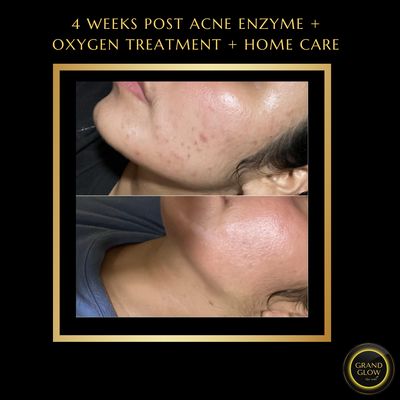 Acne Treatment Results - Over a 4-week period, clients who received the Acne Enzyme Facial experienced significant improvements in skin clarity. This facial focuses on deep cleansing and gentle enzyme exfoliation, helping to remove dead skin cells and clear clogged pores. After just two sessions, clients saw reduced inflammation and fewer active breakouts. By week four, many noticed a smoother texture and fewer acne scars.
Along with in-studio treatments, clients were provided with a customized home care routine, including a gentle cleanser, acne-fighting serums, and a light, non-comedogenic moisturizer. Consistency in this regimen helped manage oil production and prevent future breakouts. Acne Treatment Results - Over a 4-week period, clients who received the Acne Enzyme Facial experienced significant improvements in skin clarity. This facial focuses on deep cleansing and gentle enzyme exfoliation, helping to remove dead skin cells and clear clogged pores. After just two sessions, clients saw reduced inflammation and fewer active breakouts. By week four, many noticed a smoother texture and fewer acne scars.
Along with in-studio treatments, clients were provided with a customized home care routine, including a gentle cleanser, acne-fighting serums, and a light, non-comedogenic moisturizer. Consistency in this regimen helped manage oil production and prevent future breakouts.