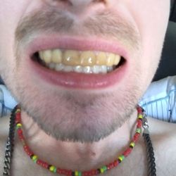 Press On Veneers