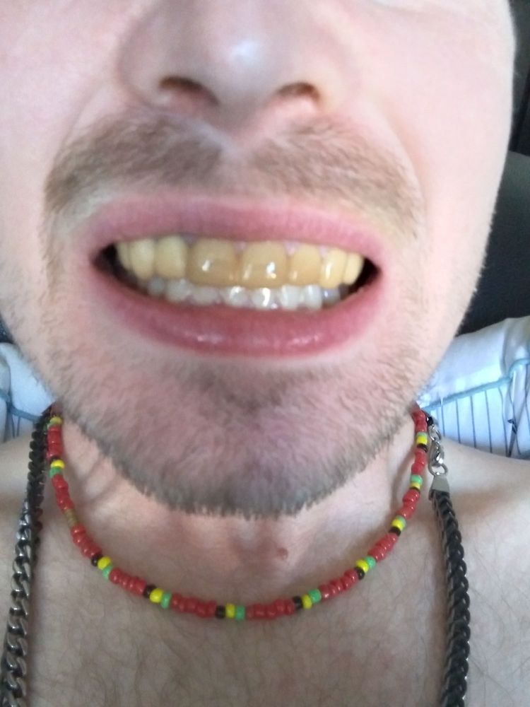 PRESS ON VENEERS Updated August 2024 26 Reviews 100 Main St, Fort