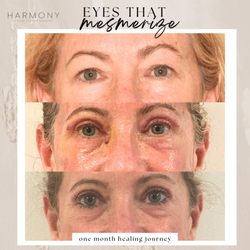 Harmony Facial Plastic Surgery- Dr. Kate O'Connor - Upper blepharoplasty (upper eyelid lift) helps open the eyes to look less tired