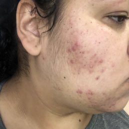 This is around May the redness is dying down and not as many breakouts