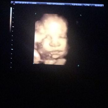 Before the Stork 4D - Ultrasound Imaging Centers Near Me - Anaheim, California
