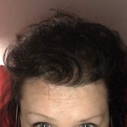 James Scheu, MD, FACS - Brow lift failed with a hairline Lowering pulled My scalp so tight that it cut off circulation for my hair gave me man Receding appearance