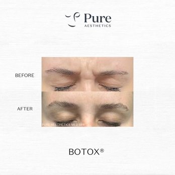 Pure Aesthetics - BOTOX at Pure Aesthetics - Medical Spas Near Me - Gainesville, Florida