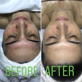 Tina Esthetics - Chemical peel - Waxing Near Me - Glendale, California Tina Esthetics - Chemical peel - Waxing Near Me - Glendale, California