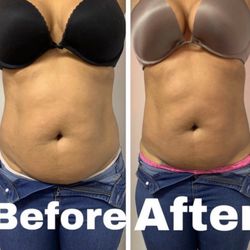 Ynobe Beauty Lounge - Progress photos of laser Lipo + Lipo Cavitation
