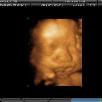 Before the Stork 4D - Baby Han!  Jenn captured him even though he was being difficult.  LOVE these photos. - Ultrasound Imaging Centers Near Me - Anaheim, California