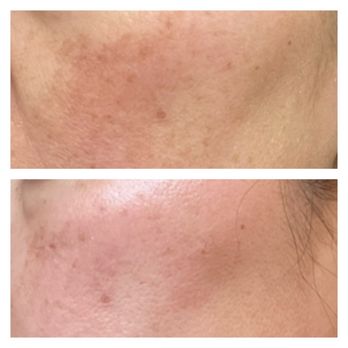 NuGlow Wellness Med Spa - Dark spots are almost gone and my skin looks so good. - Medical Spas Near Me - Irvine, California NuGlow Wellness Med Spa - Dark spots are almost gone and my skin looks so good. - Medical Spas Near Me - Irvine, California