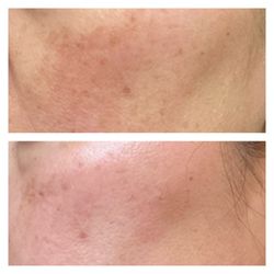 NuGlow Wellness Med Spa - Dark spots are almost gone and my skin looks so good.