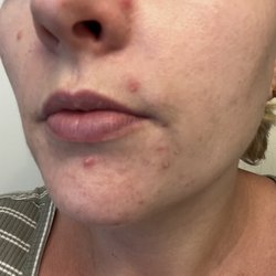 Skin Deep By Christine - Break outs around my mouth and chin area.
