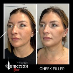 The Injection Bar - Cheek filler- natural yet refreshed