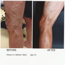 Fox Valley Vein Centers - Before & After