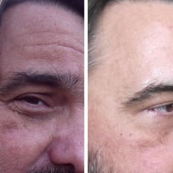 San Diego UltraSlim - Terry's Photo Facial before and after.