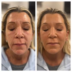 NovaGen Skin & Wellness - PDO Threads Lift