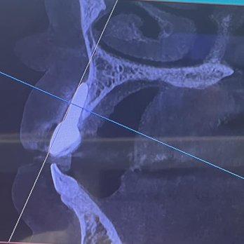 Illinois Valley Oral Surgeons - The implant removed in 2024 - Oral Surgeons Near Me - Ottawa, Illinois Illinois Valley Oral Surgeons - The implant removed in 2024 - Oral Surgeons Near Me - Ottawa, Illinois