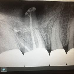 Amit Batheja, DDS - 3 visit molar root canal treatment