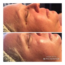 The Orange Blossom Spa - Hydrafacial before and after one treatment.