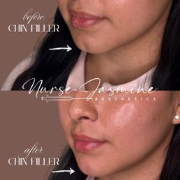Chin filler