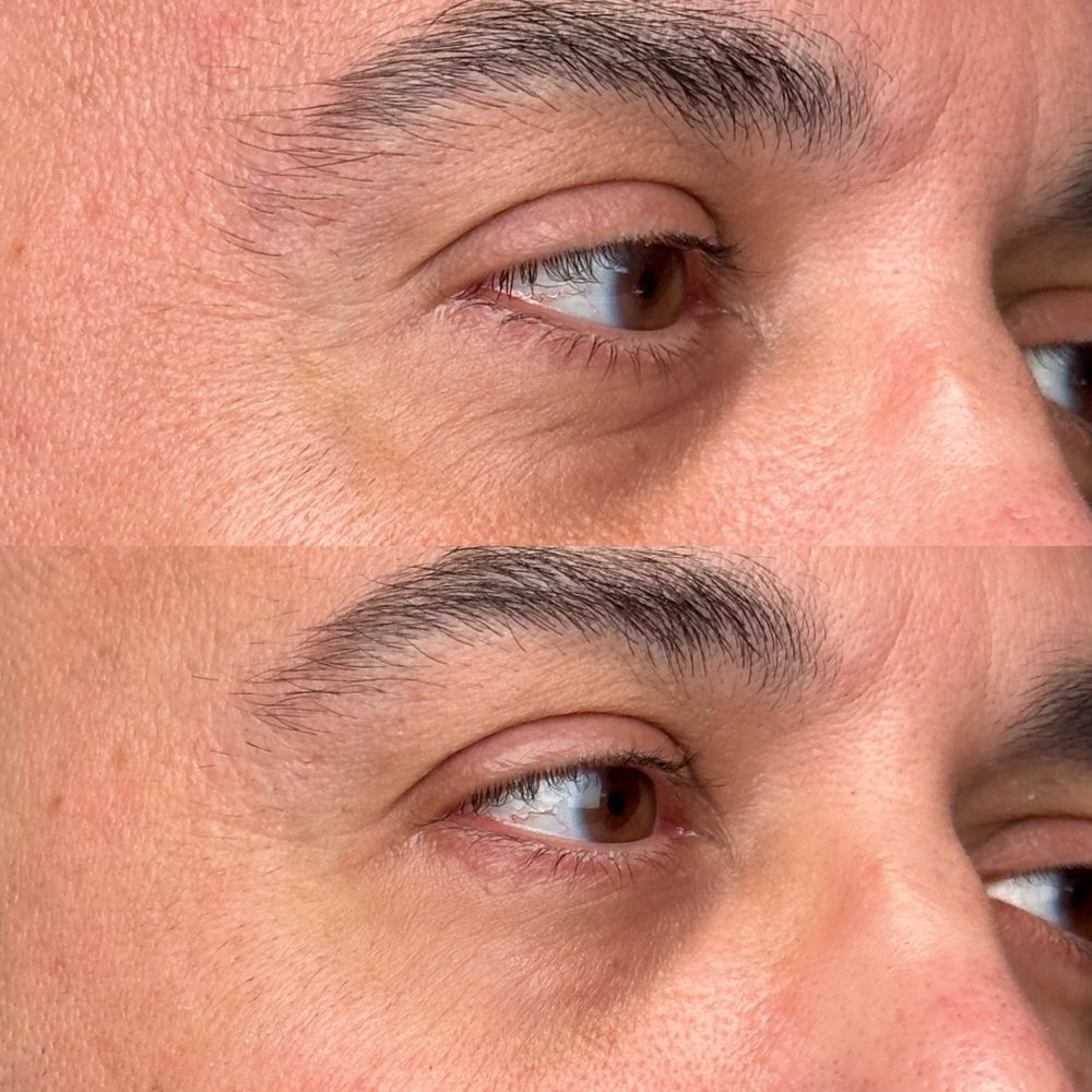 Fibroblast Facelift - Skin Care Near Me - Pasadena, California