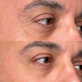 Fibroblast Facelift - Skin Care Near Me - Pasadena, California Fibroblast Facelift - Skin Care Near Me - Pasadena, California