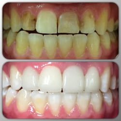 Harmony Dental Group - 4 all porcelain crowns to address fractures and decay