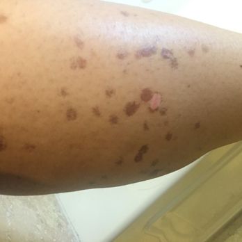Defining Beauty - Stay away from this lady! Bernadette (owner) is not a professional laser technician as she so claims. She has caused severe skin damage!!!!! - Tattoo Removal Near Me - Greenville, New York