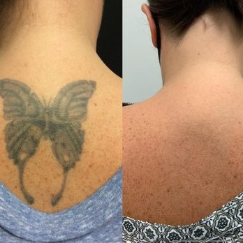 Removery Tattoo Removal & Fading - Tattoo Removal Near Me - Knoxville, Tennessee Removery Tattoo Removal & Fading - Tattoo Removal Near Me - Knoxville, Tennessee