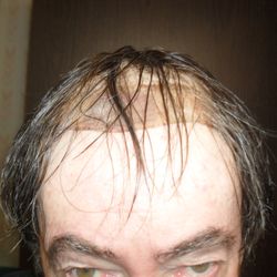 Courtesy of Maria Jaggard Salon/Vancouverhairloss.com located in Langley, B.C. 16 months after purchasing new hair system.