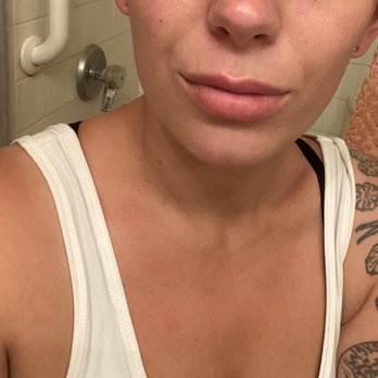 Clear Skin Spa - After with no red skin at all or any irritation! amazing to me - Medical Spas Near Me Clear Skin Spa - After with no red skin at all or any irritation! amazing to me - Medical Spas Near Me
