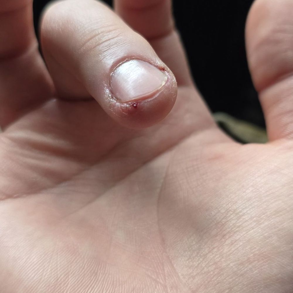 Finger cut Finger cut
