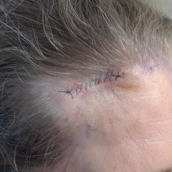 Forefront Dermatology - Dr. Condon did such a pretty job stitching me up after mole removal. - Dermatologists Near Me - Thousand Oaks, California Forefront Dermatology - Dr. Condon did such a pretty job stitching me up after mole removal. - Dermatologists Near Me - Thousand Oaks, California