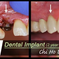 Village Oaks Dentistry - Dental Implant. 2-year revisit.