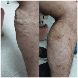 Varicose Vein Laser Center & Med Spa - Healing Phase Post Treatment