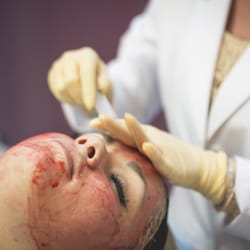 SliMedica - A client receives a Vampire Facelift.