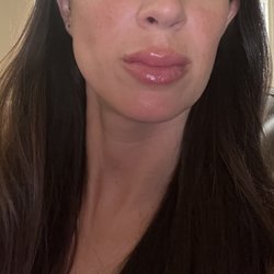 Plastic Surgery Vegas - Lip treatment