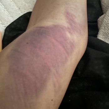 CSL Plasma - My arm after 2nd collapsed vein - Blood & Plasma Donation Centers Near Me - Charlotte, North Carolina CSL Plasma - My arm after 2nd collapsed vein - Blood & Plasma Donation Centers Near Me - Charlotte, North Carolina