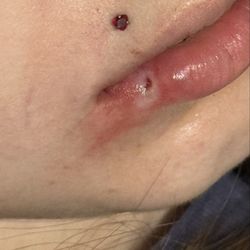 Cardon & Sorrow - What it looked like when we took the gauze off.