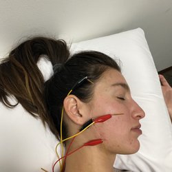 Peak Performance & Rehab - Dry needling used to treat TMJ pain and headaches