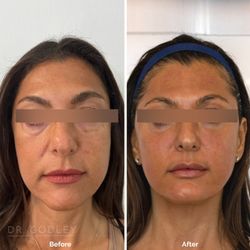 Godley Clinic - Radiesse filler and Morpheus8 for a non-surgical face lift.