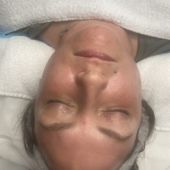 Renata Skin Studio - Microneedling for skin rejuvenation. - Medical Spas Near Me - Roswell, Georgia Renata Skin Studio - Microneedling for skin rejuvenation. - Medical Spas Near Me - Roswell, Georgia