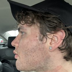 Khronos MedSpa - CO2 laser that i just got done