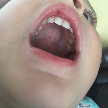 PDQ Chicken - The inside of my sons mouth after the metal went threw the roof of his mouth. - Sandwiches Near Me - Gainesville, Florida