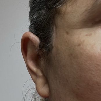 VIDA - Dr. Quiroz- 3 months s/p neck and face lift- Erroneous left ear reattachment below the eye angle); bump on left temple - Body Contouring Near Me - Tijuana, BCN VIDA - Dr. Quiroz- 3 months s/p neck and face lift- Erroneous left ear reattachment below the eye angle); bump on left temple - Body Contouring Near Me - Tijuana, BCN