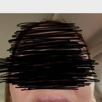 Blanco Smile Dentistry - It's just white stain marks that went away it didn't stay like this, not worth $250 in office. - General Dentistry Near Me - Fallbrook, California