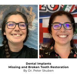 Newport-Mesa Orthodontics & Family Dentistry - Dr. Peter Skuben restored two missing teeth with custom dental implants and implant crowns for a beautiful smile and last confidence.