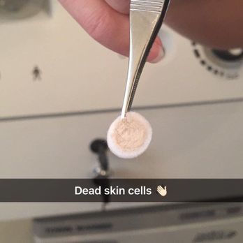 Vital Skin Care Studio - All the dead skin cells sucked off by the Dermasweep. - Skin Care Near Me - San Jose, California Vital Skin Care Studio - All the dead skin cells sucked off by the Dermasweep. - Skin Care Near Me - San Jose, California