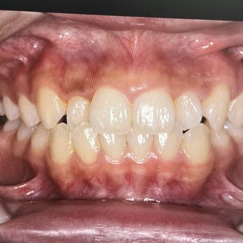 Christopher H Nguyen, DMD, MSD - before - Orthodontists Near Me - Santa Ana, California
